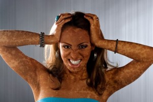 Re Vitiligo